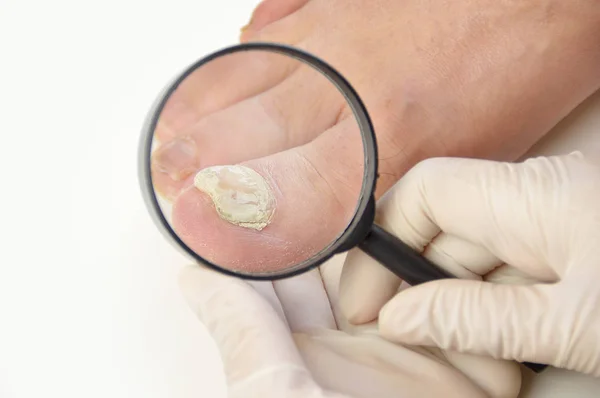 Podiatrist checking a sick nail — Stock Photo, Image