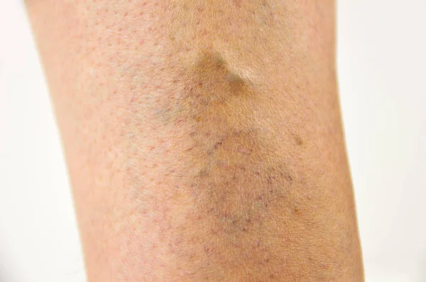 Варикозные вены на ноге — стоковое фото