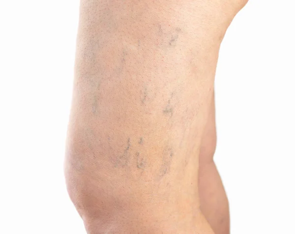 Varicose veins in the leg — Stock Photo, Image