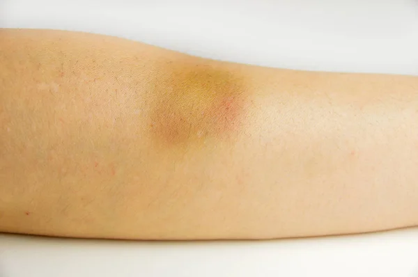 Bruise in the arm — Stock Photo, Image