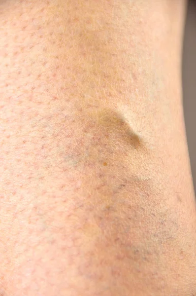Veias varicosas em uma perna — Fotografia de Stock