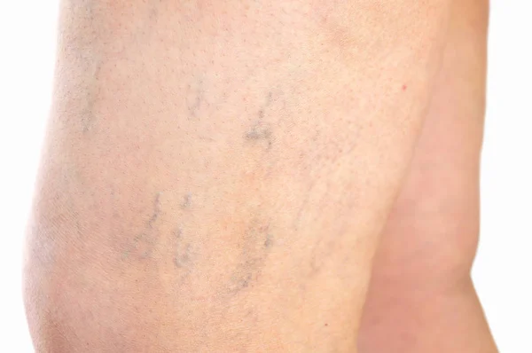 Varicose veins on a leg — Stock Photo, Image