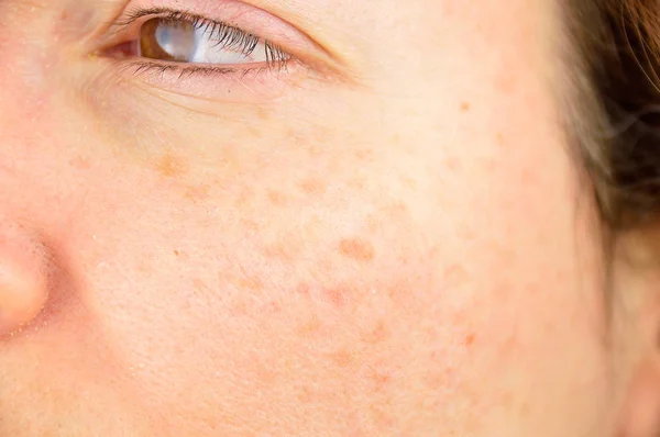 Skin of woman with blemish and spots — Stock Photo, Image