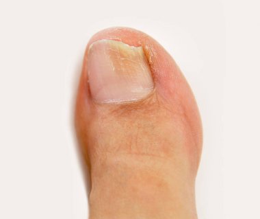 fungal nail infection clipart