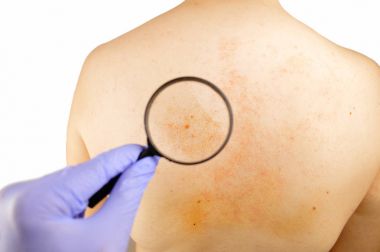 Checking psoriasis on the back of a man clipart