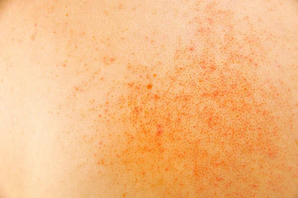 Close Van Zieke Huid Met Atopische Dermatitis — Stockfoto