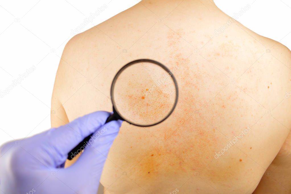 Checking psoriasis on the back of a man