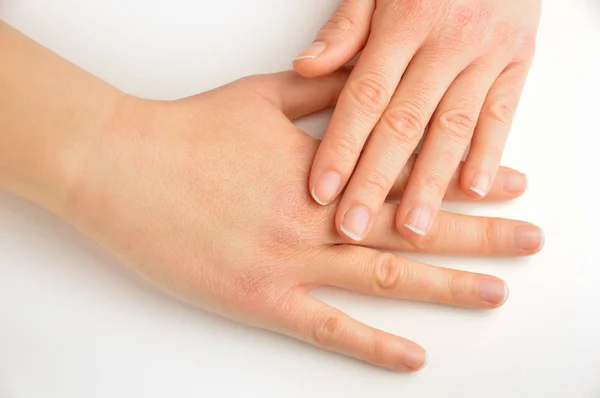 Mãos tocando com a pele seca — Fotografia de Stock