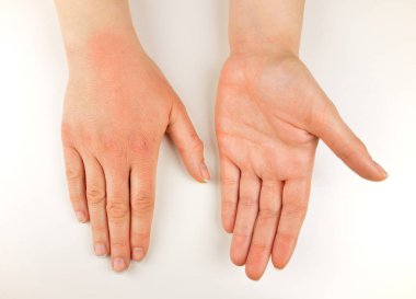 solmuş el soğuk hava ile