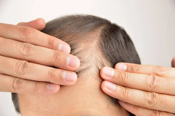 Closeup of man with receding hair — Stock Photo, Image