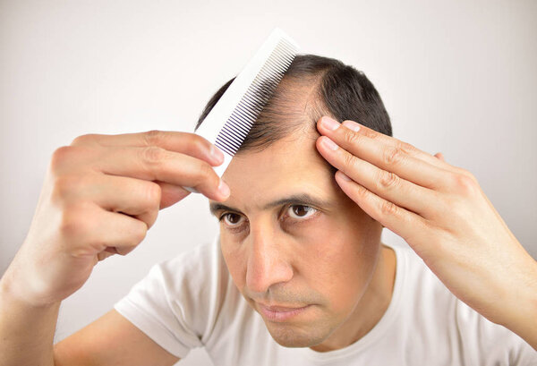 man with receding hair