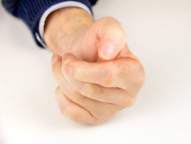 Romatoid artrit deforme el 