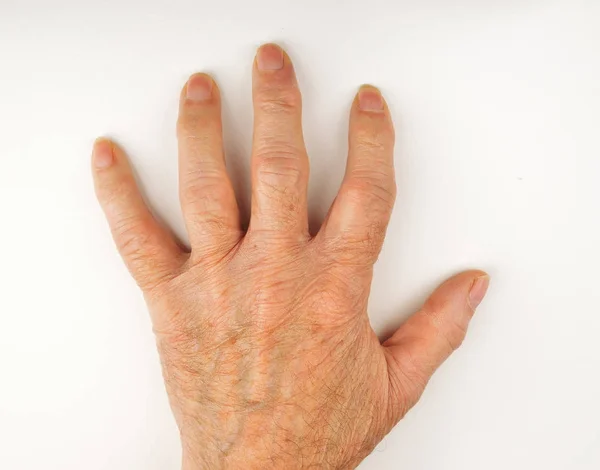 Romatoid artrit deforme el — Stok fotoğraf