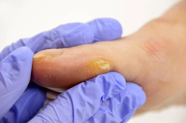 Callus on toe — Stock Photo, Image