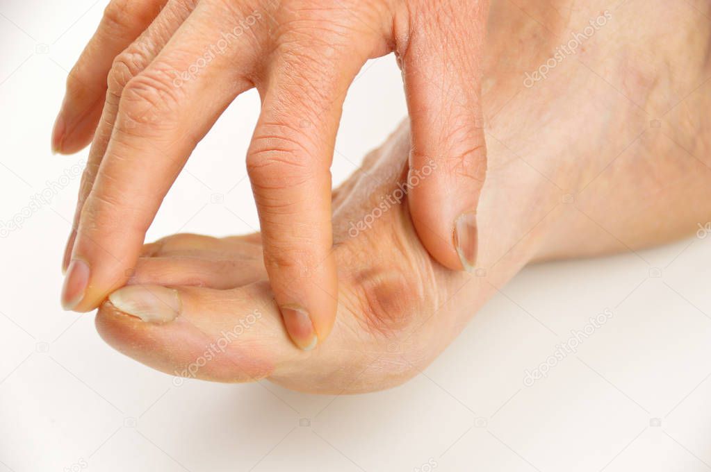 Foot with a bunion