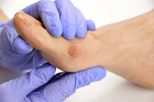 Voet met een bunion — Stockfoto