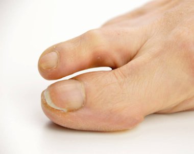  foot with calluses clipart