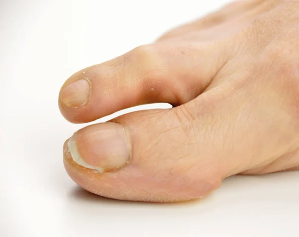 Fuß mit Schwielen — Stockfoto
