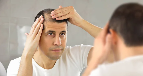 Homme avec perte de cheveux — Photo