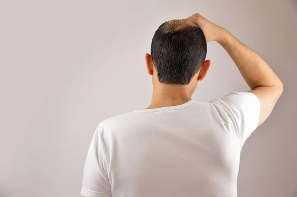 Человек с выпадением волос — стоковое фото