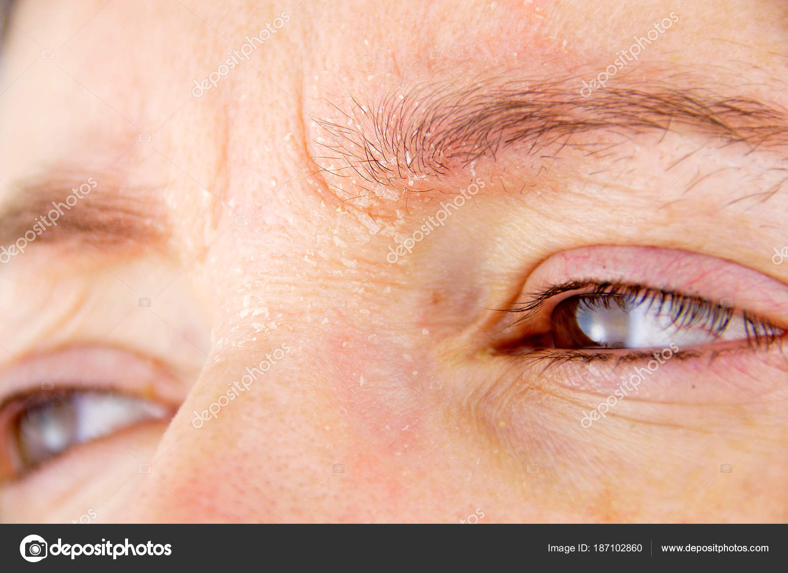 Woman With Atopic Dermatitis Stock Photo By C Cunaplus