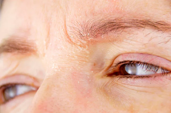 Vrouw met atopische dermatitis — Stockfoto