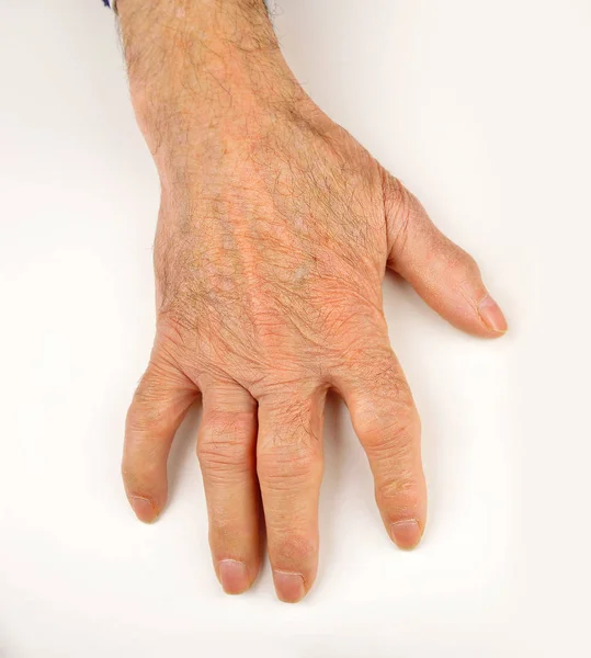류 마티스 관절염에서 변형 하는 손 — 스톡 사진