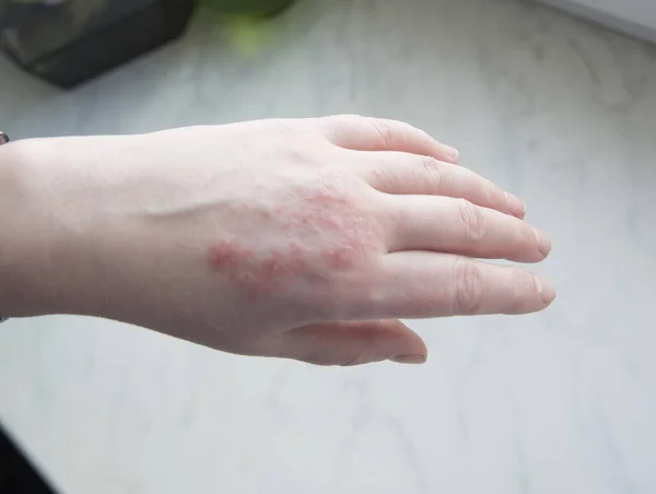 Hautreizung Schuppenflechte Hand Nahaufnahme auf der Fensterbank — Stockfoto