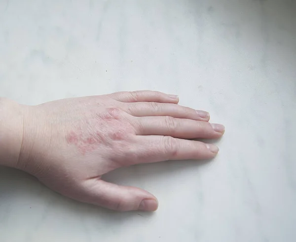 Hautreizung Schuppenflechte Hand Nahaufnahme auf der Fensterbank — Stockfoto