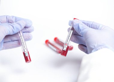 Coronavirus acil durum eli beyaz üzerinde kan olan koronavirüs test tüpünü tutuyor.