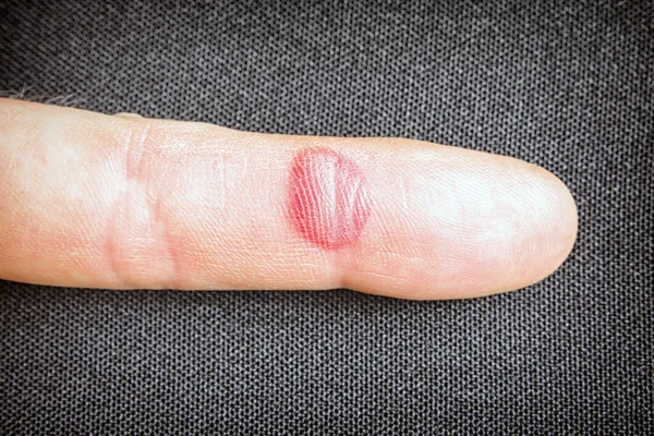 Кровавая ссадина на пальце — стоковое фото