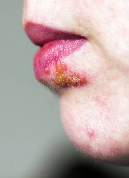 Herpes op lip — Stockfoto