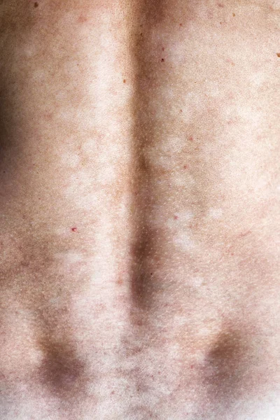 Tinea Versicolor Πιτυρίαση Versicolor Μυκητιασική Λοίμωξη Του Δέρματος — Φωτογραφία Αρχείου