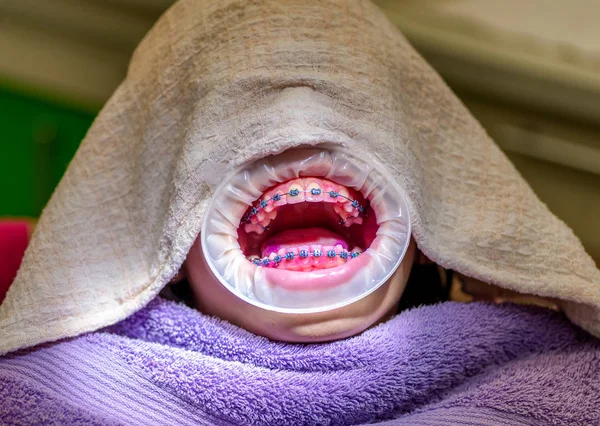 Paciente com aparelho ortodôntico e afastador de bochechas em clínica odontológica — Fotografia de Stock