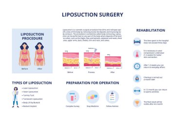 Liposuction body plastic surgery with characters and text, vector illustration. clipart