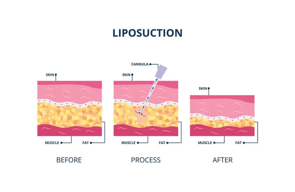 Procedimento de lipoaspiração assistida por sucção - ilustração vetorial de camadas cutâneas isolada . — Vetor de Stock