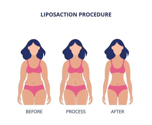 Procedimento de lipoaspiração antes e após banner ilustração vetorial plana isolado . —  Vetores de Stock