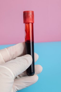 COVID 19 Coronavirus Örnek tüpte enfekte kan örneği.