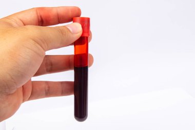 COVID 19 Coronavirus Örnek tüpte enfekte kan örneği.