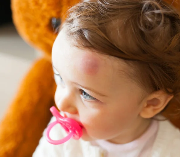 Toddler with big bruise on his forehead after bumping. — Stock Photo, Image