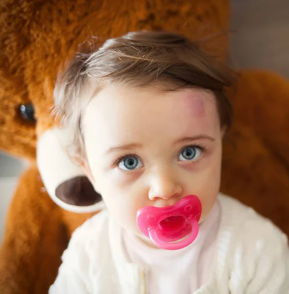 Toddler with big bruise on his forehead after bumping. — Stock Photo, Image