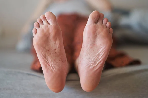 Eczema en los pies de una joven . — Foto de Stock