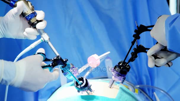 Laparoskopi ameliyatı gerçekleştiren uzman ekip — Stok video
