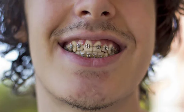 Portrait Young Handsome Man Braces Home — Stock Photo, Image