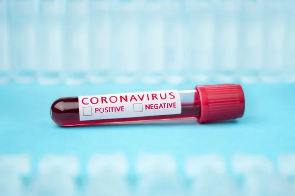 Ιός του Coronavirus covid-19 μολυσμένο δείγμα αίματος σε σωλήνα δείγματος. Έρευνα για το εμβόλιο του ιού Coronavirus covid-19. Νοσηλευτική. Ιστορικό κλινικής. Επιδημία, πανδημία. Ιατρική μολυσματική έννοια — Φωτογραφία Αρχείου