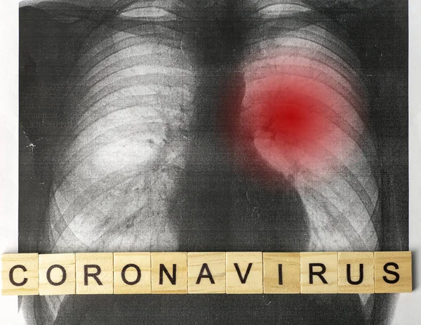 Concepto epidémico de Coronavirus 2019-ncov. Coronavirus en el pictu — Foto de Stock