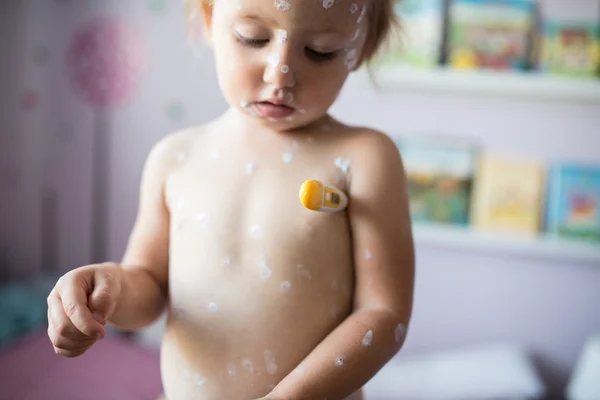 Little girl with chickenpox — Stock Photo, Image