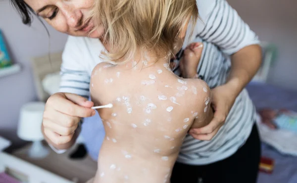 Mother with Little girl ill with chickenpox — Stockfoto