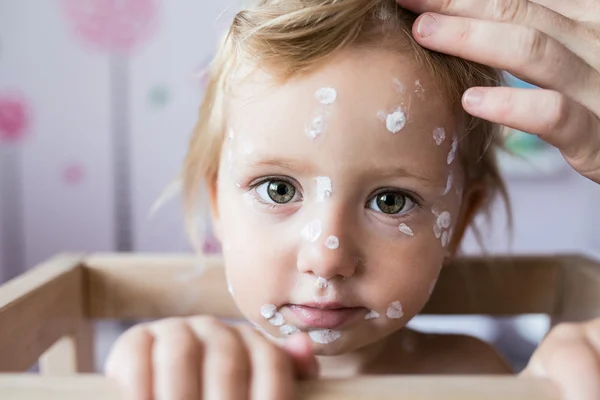 Little ill girl with chickenpox — Stock Photo, Image