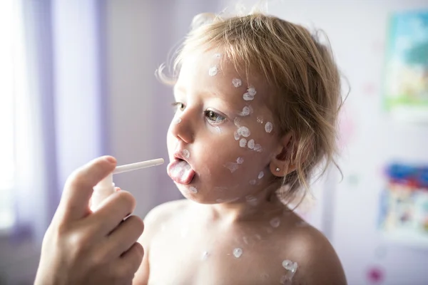 Little ill girl with chickenpox — Stock Photo, Image